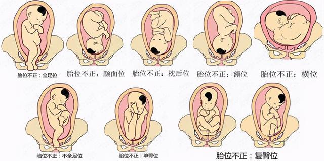 寶寶胎位不正你會看嗎？