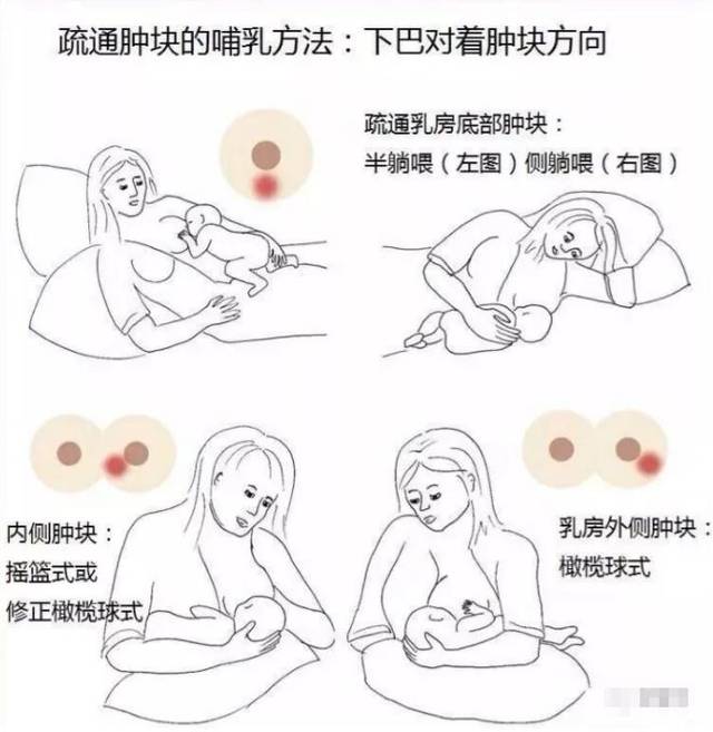產(chǎn)后漲奶，疼痛難忍怎么辦？