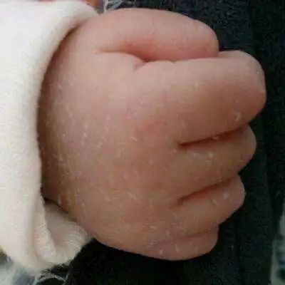 新生兒脫皮是正常的嗎？