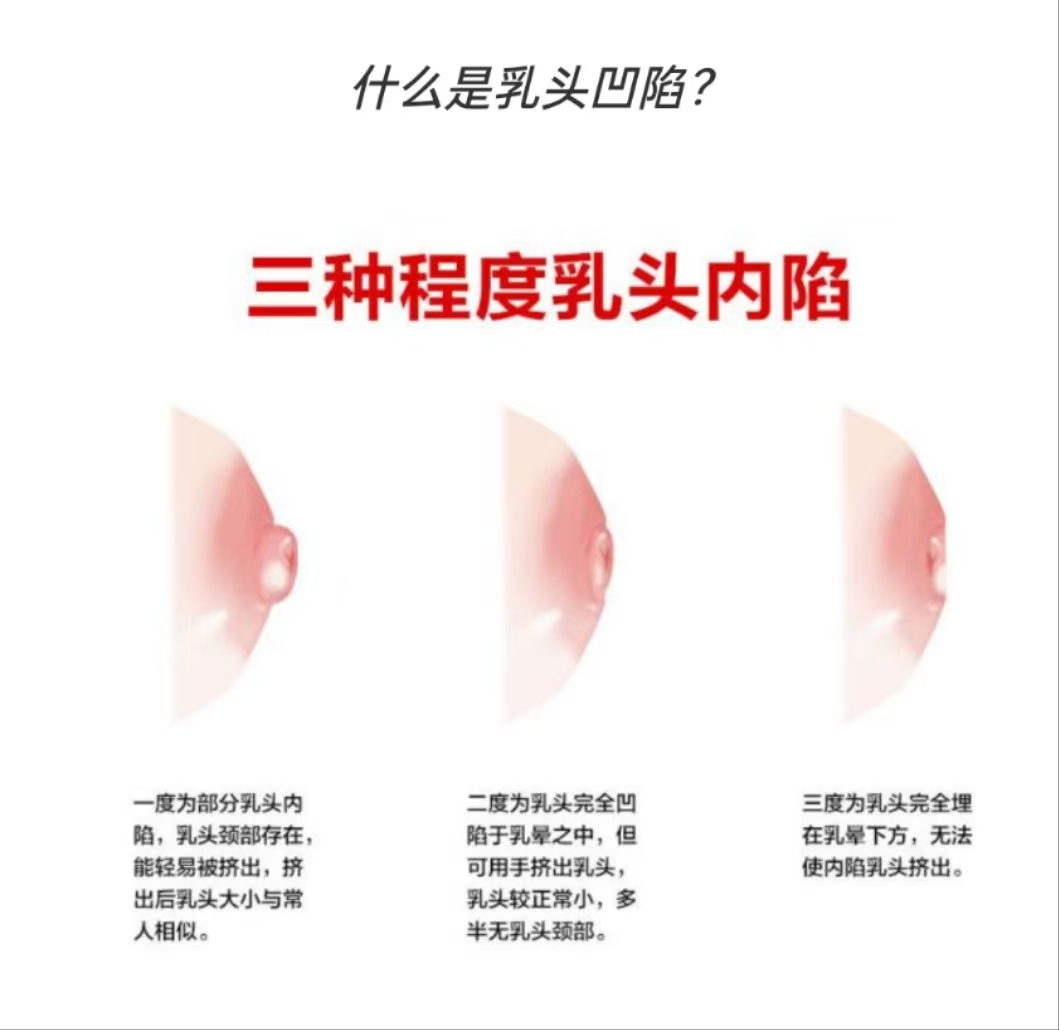 乳頭凹陷的媽媽該如何哺乳？