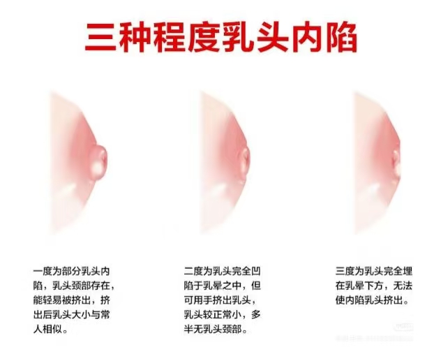 乳頭凹陷的媽媽該如何哺乳？